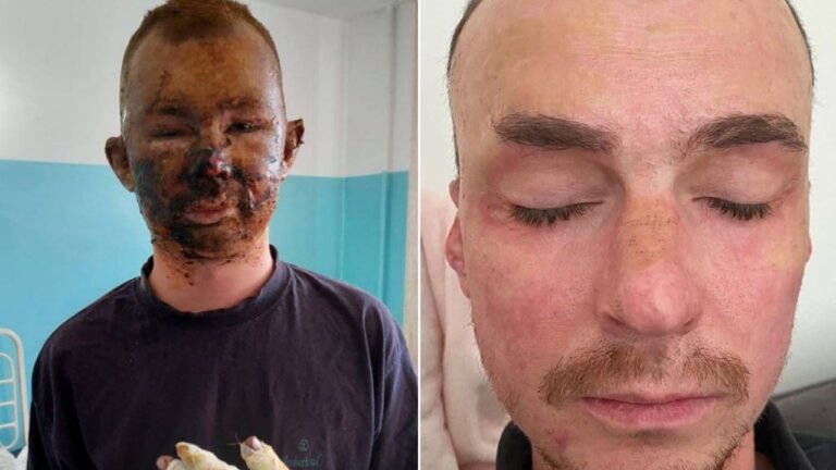 “Що довше я дома, то важче уявляти прощання”: Йосип Ловска про службу та особливості реабілітації після поранення